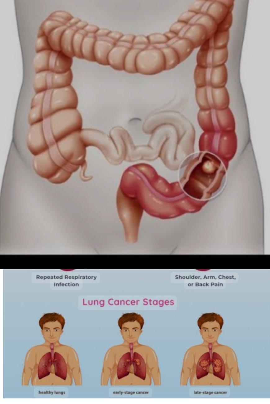 "Unveiling the Surge: Why Lung and Intestinal Cancers Are Rising Among the Youth"