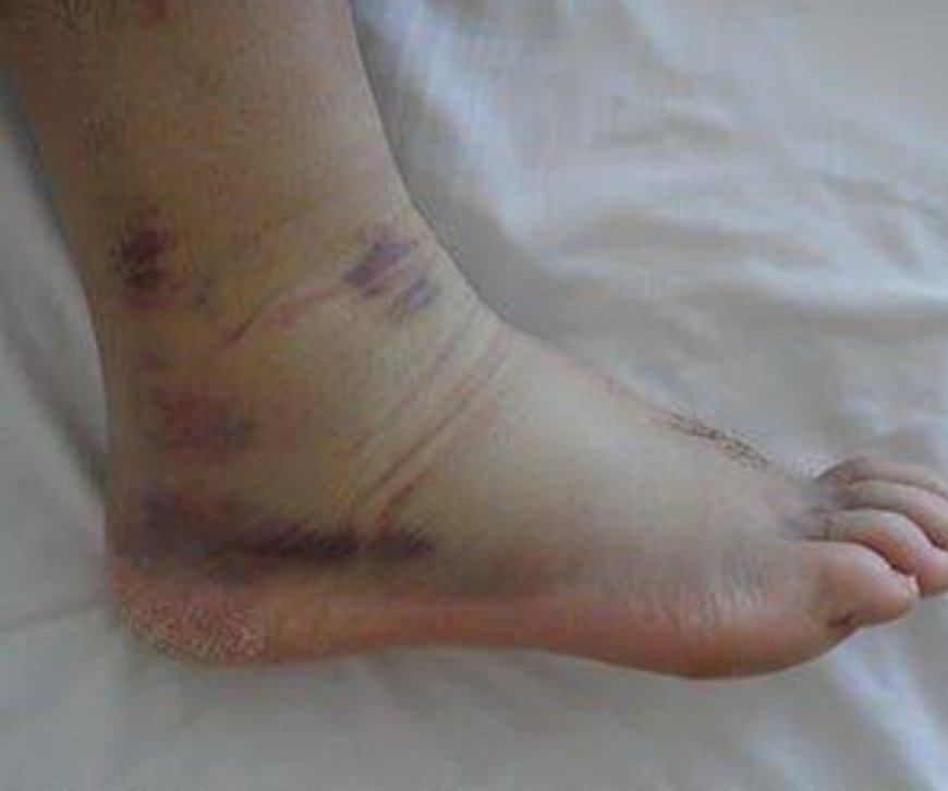6 supplements to shrink swollen Ankles