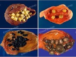 Gallbladder Stones (causes and symptoms).......