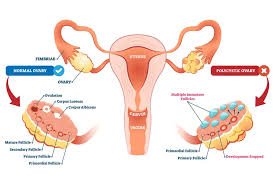 Reversing PCOS in a Month: Boosting Fertility and Getting Pr