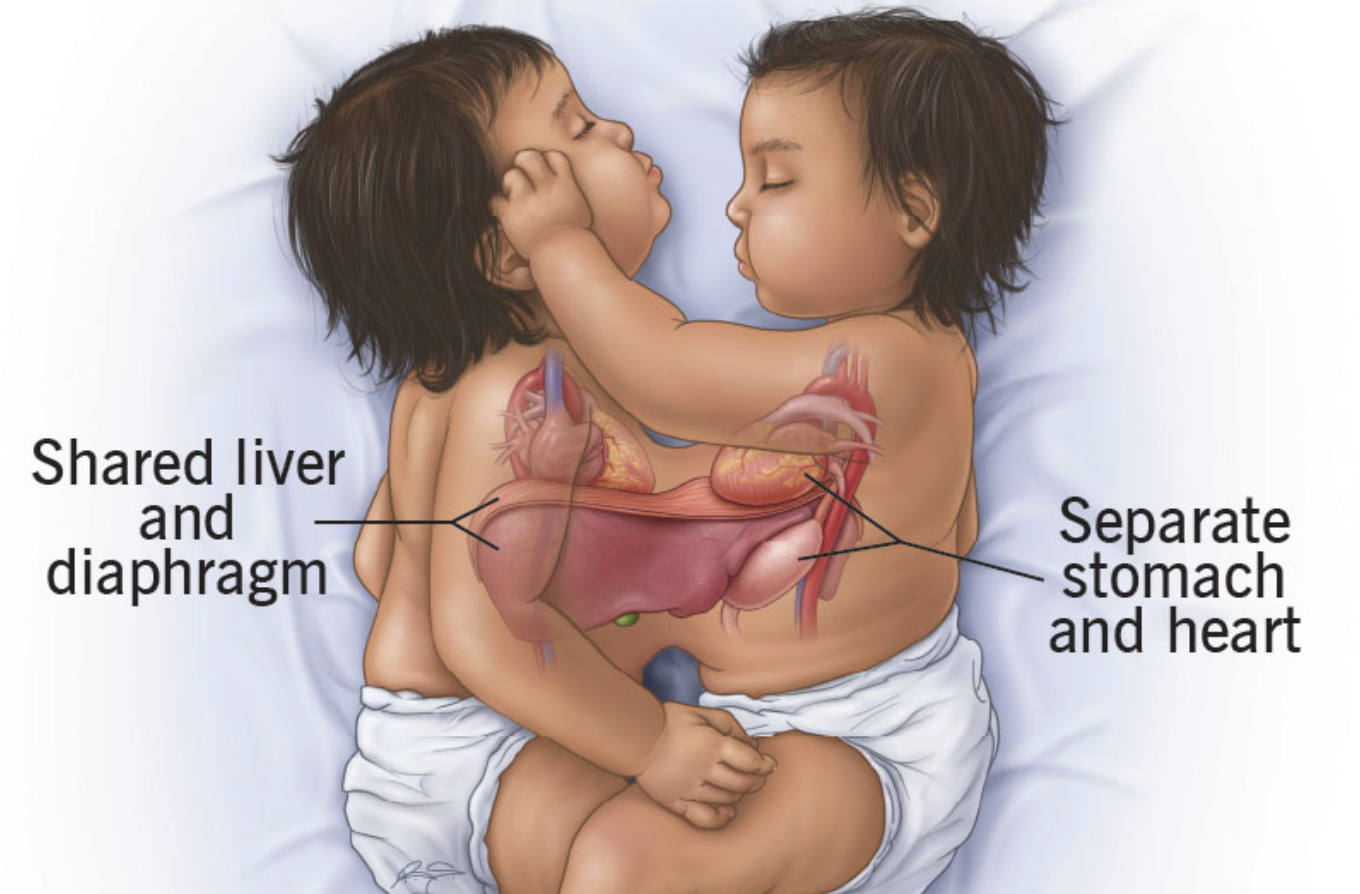 How do conjoined twins form in the womb?...