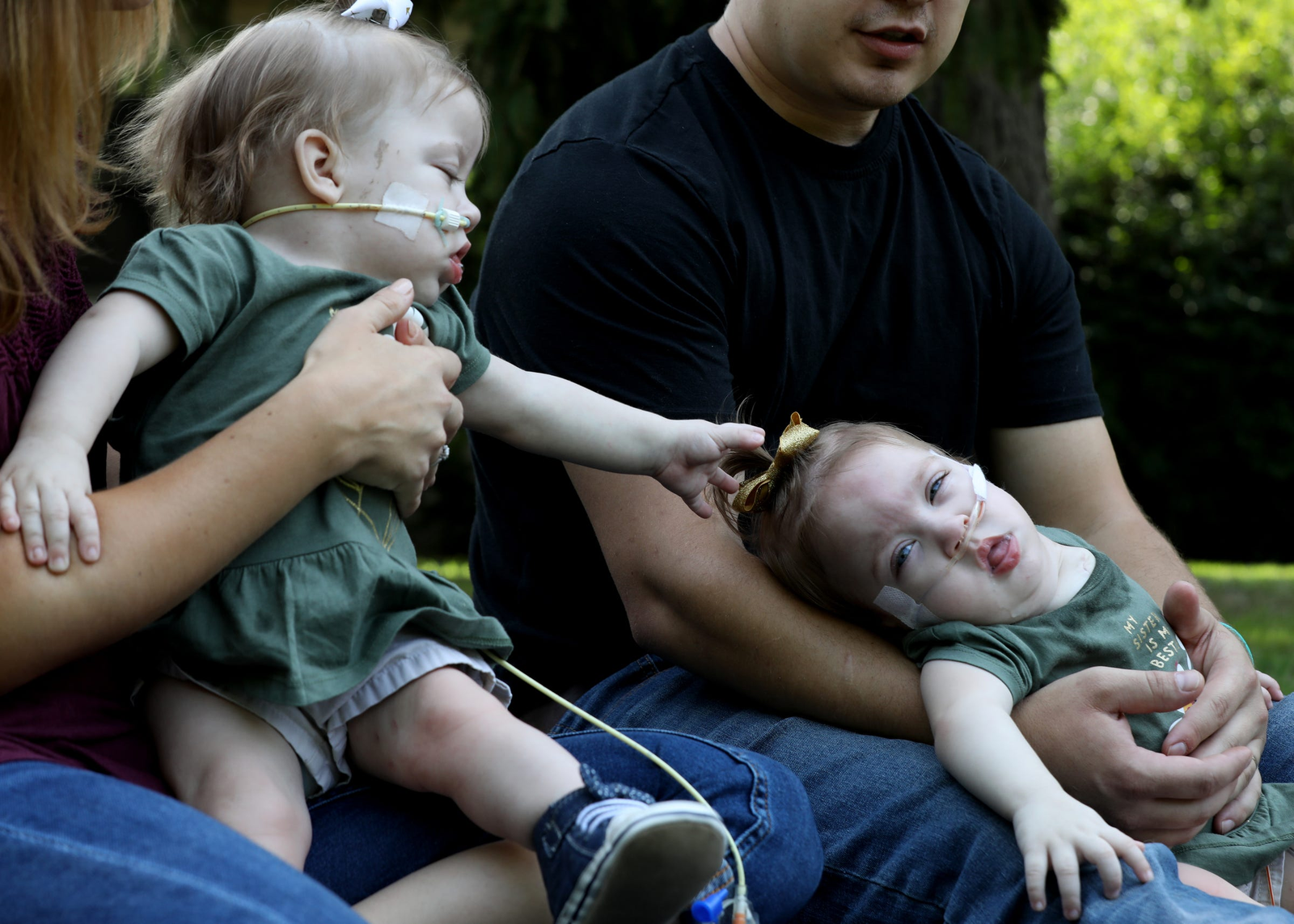 How rare are conjoined twins, and why are some types more co...