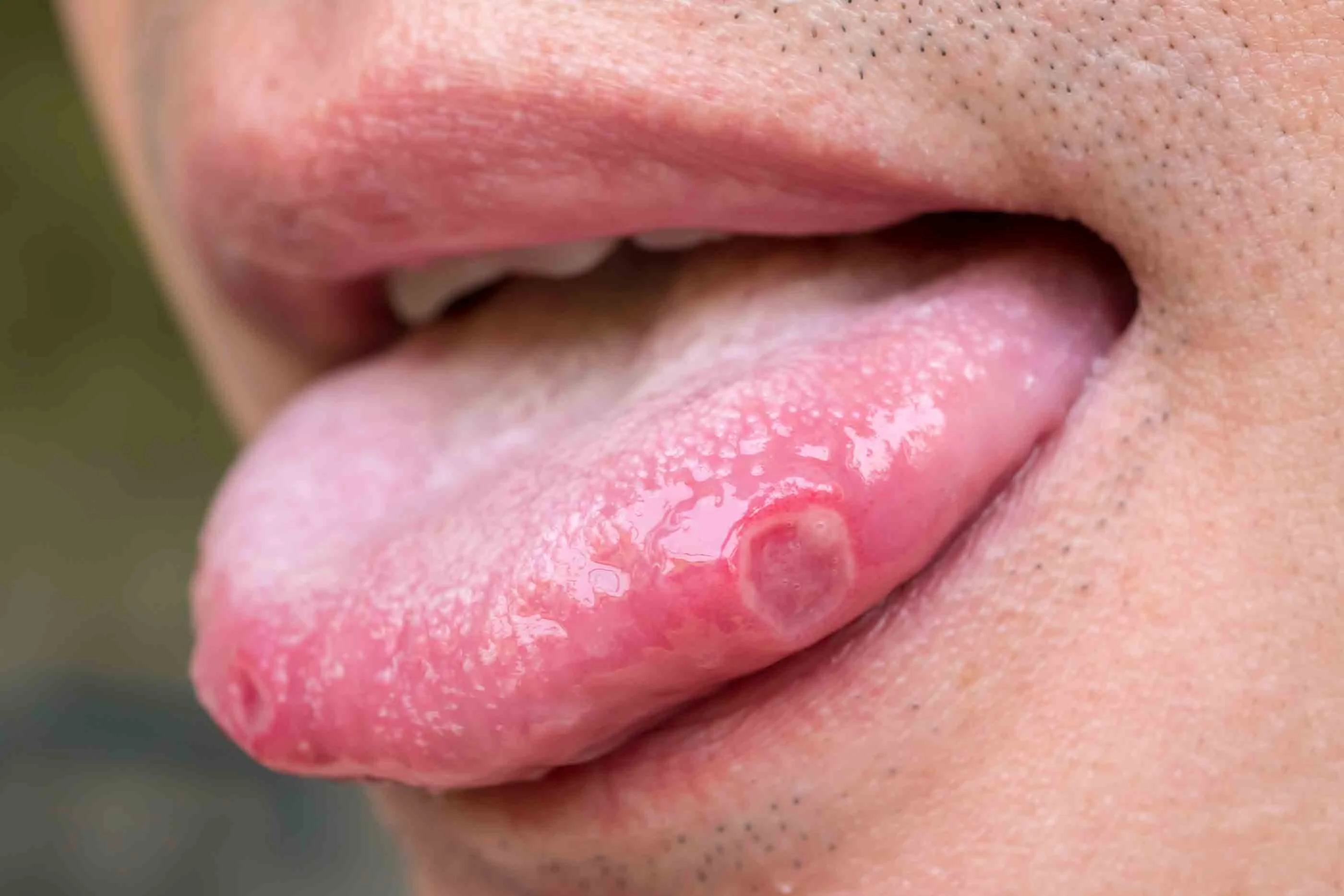 What do you think about syphilis as an STD? Is it dangerous ...