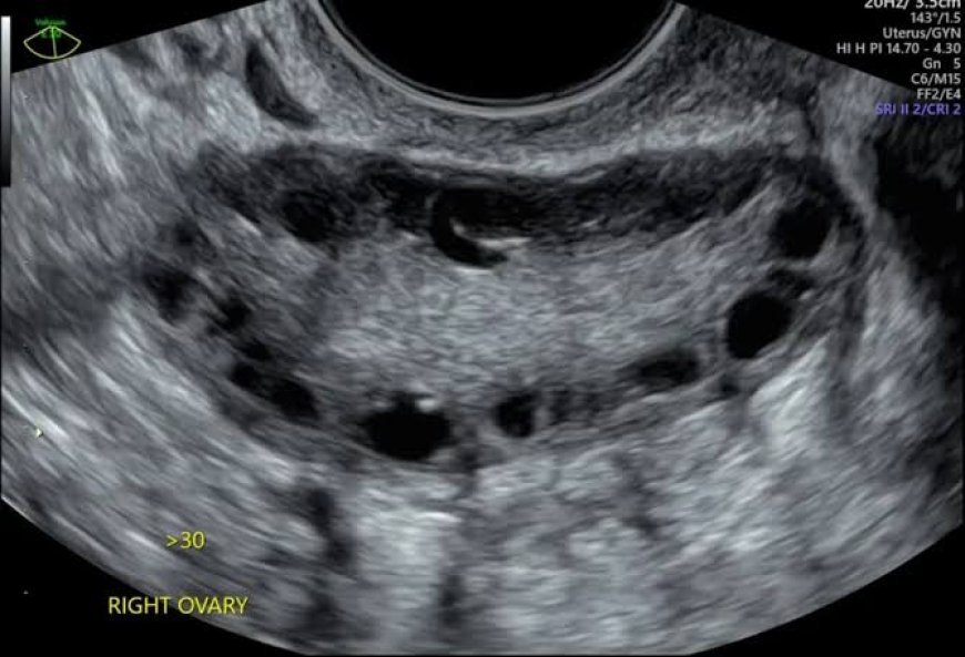 Polycystic ovary syndrome management