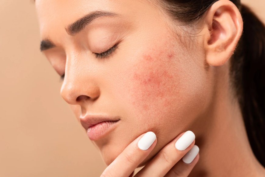 How to Remove Pimples Naturally and Permanently Top 10 tips