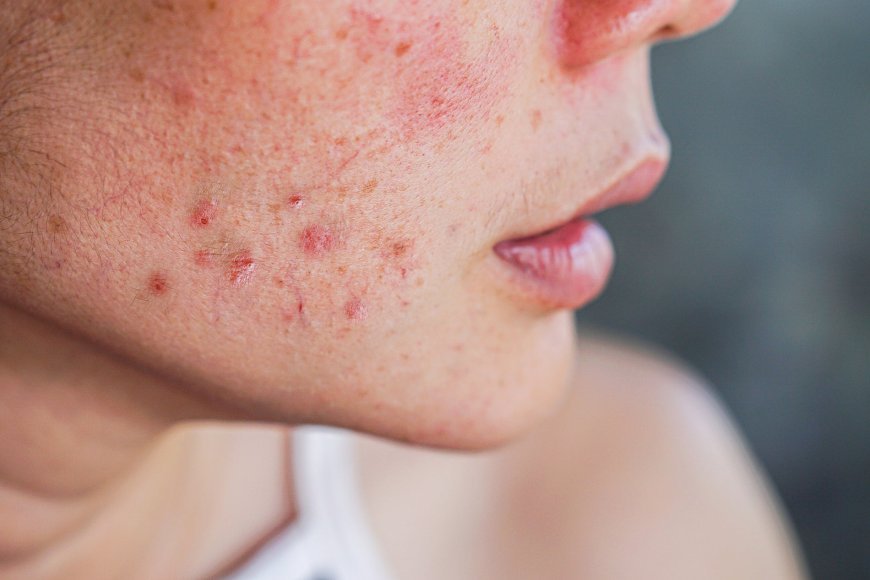 How to Remove Pimples Naturally and Permanently Top 10 tips