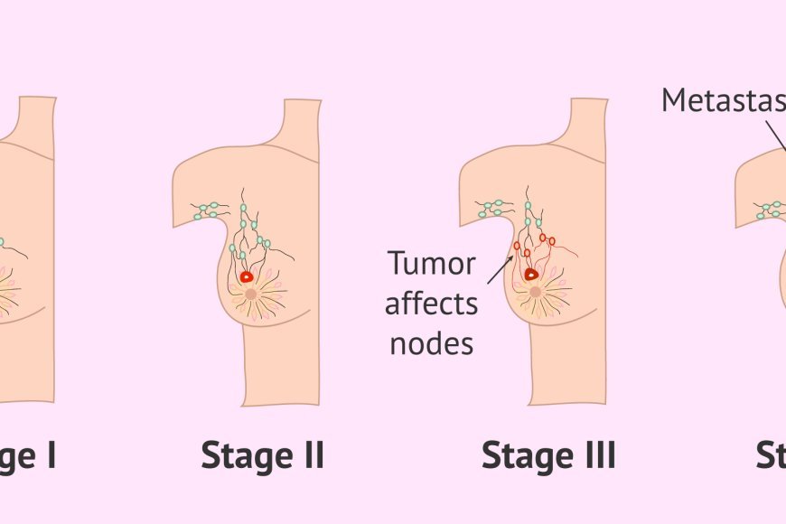 A Complete Guide to the Stages of Breast Cancer