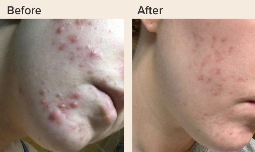 Top 6 Natural Solutions to Clear Skin and Fight Acne