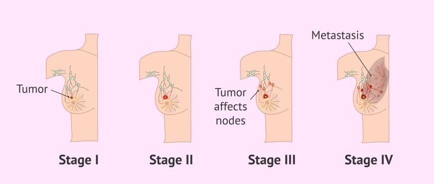 A Complete Guide to the Stages of Breast Cancer