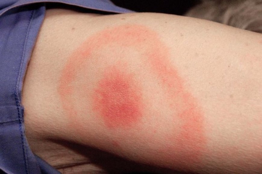 All You Need to Know About Lyme Disease